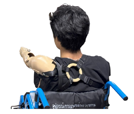 Figure 2: A.R.M. and harness design fitted to a BCMF patient. 
