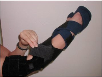 Figure 2 shows the elbow wrap and the hand splint modeled on a potential patient.  The hand splint, manufactured by Sammons-Preston, is made of a malleable aluminum frame that is covered with a removable soft blue lining.  The straps and removable finger separators are also made of this blue lining.  The splint holds the hand in a neutral arced position with a thumb strap and two straps that cover the fingers and the knuckles of the hand.  Two additional straps wrap around the forearm and the base of the hand splint.  These straps have been extended with 14 Velcro straps partially lined with 4 &frac34;  X 2  and 2 7/8  X 1 5/8  neoprene rectangles to serve as supination/pronation restraint straps.  These straps wrap around the arm in opposing directions. 
